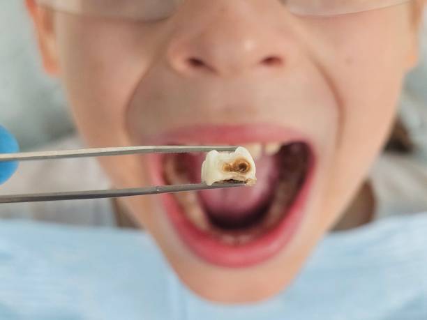 Best Emergency Tooth Extraction in Lyles, TN